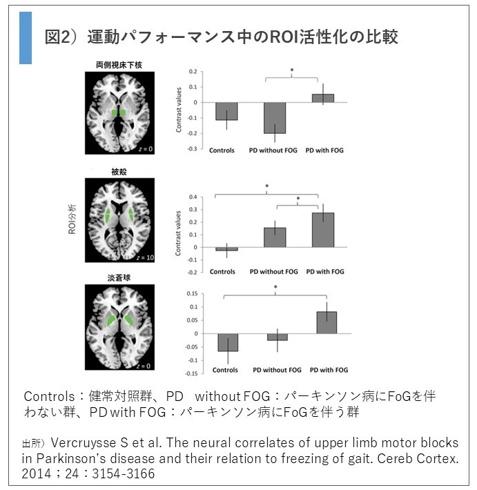 パーキンソン病の臨床症状について 2 無動 Xpert