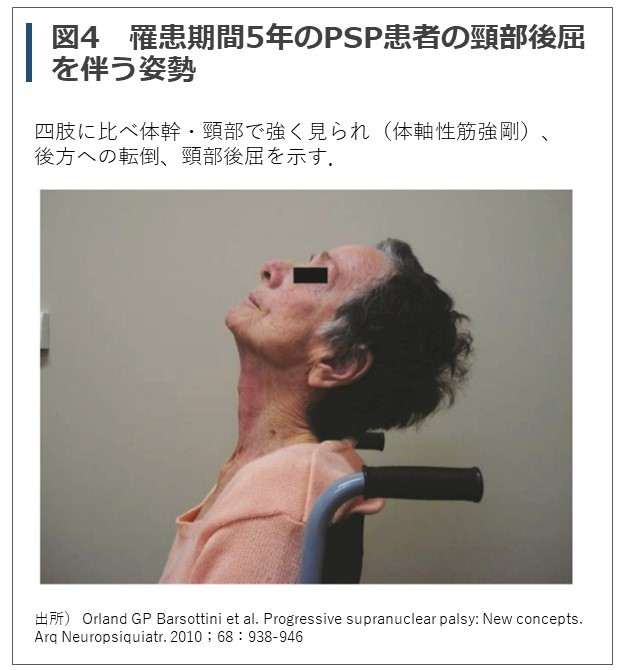 パーキンソン症候群を示す原因疾患について ｜ XPERT