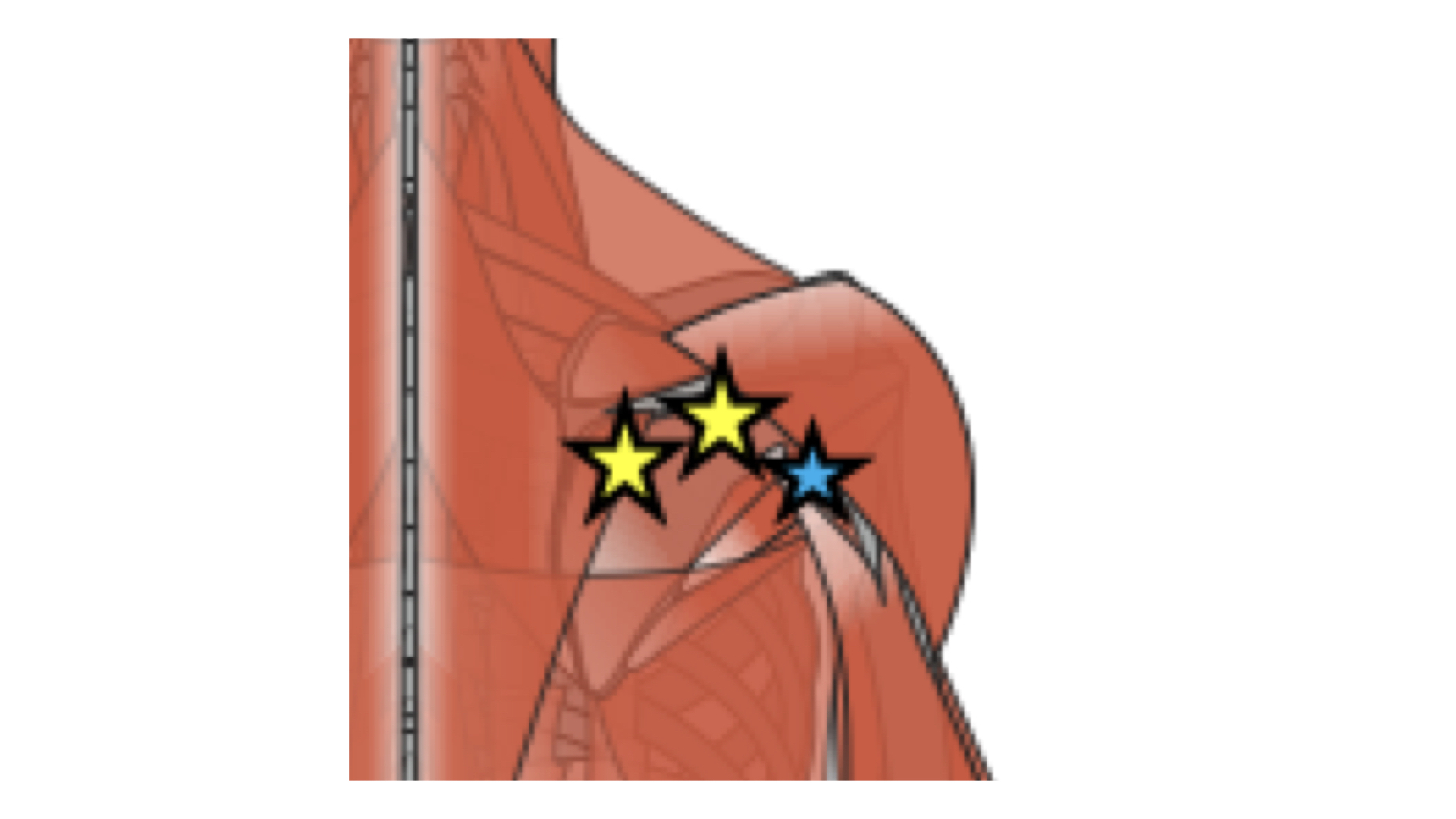 肩峰下インピンジメント症候群に対してのコンディショニング 肩甲上腕関節に対して Xpert