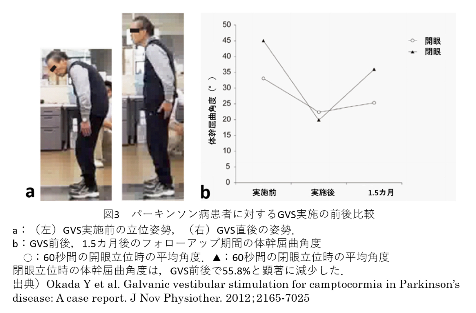 パーキンソン病患者に対するリハビリテーション Xpert