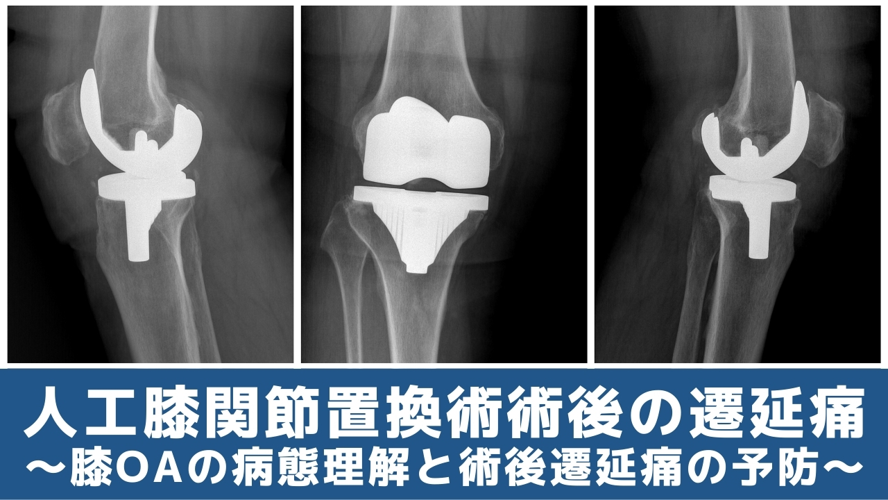 人工膝関節置換術後の遷延痛～膝OAの病態理解と術後遷延痛の予防 