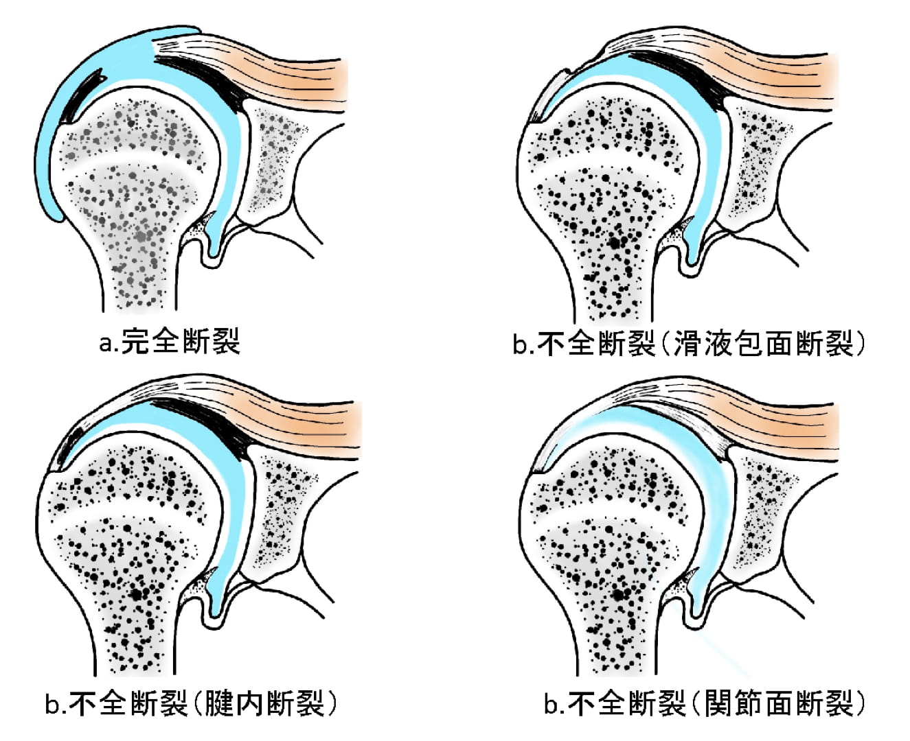 肩腱板断裂における術後リハビリテーション−術後再断裂の原因について