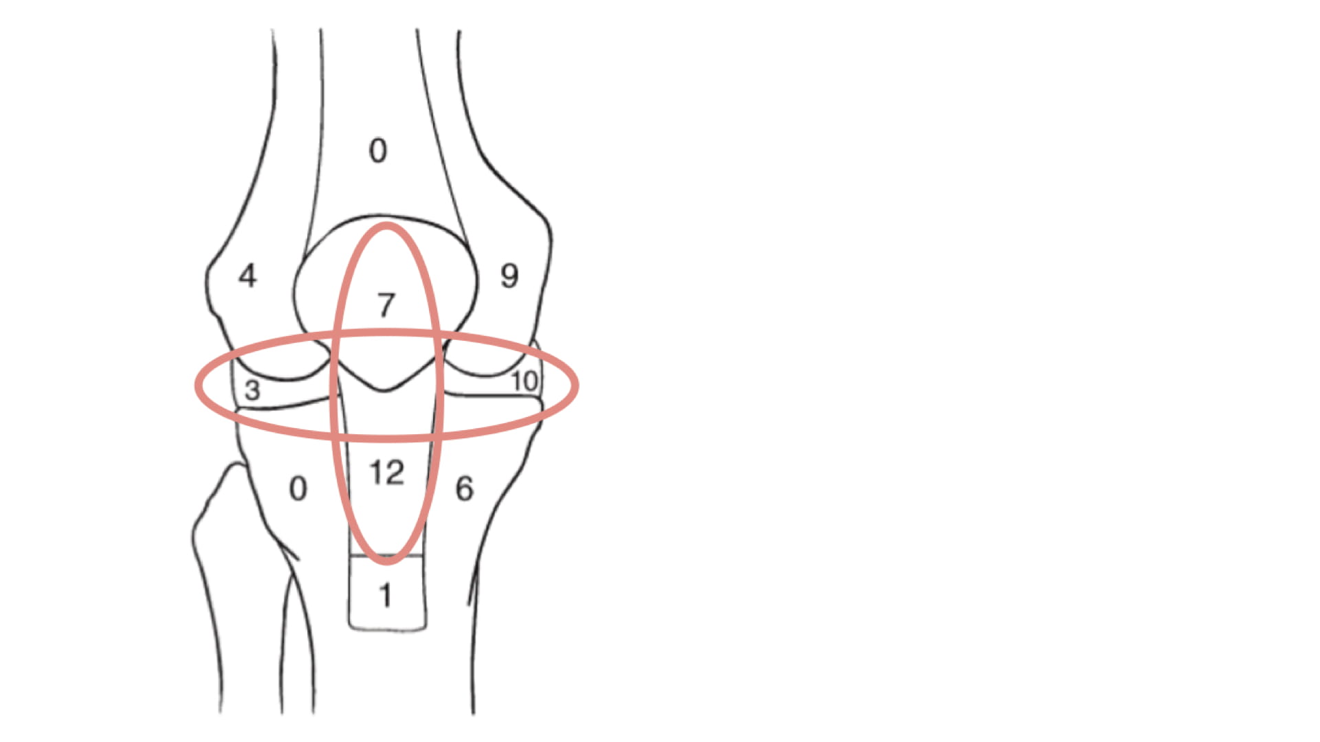 前十字靭帯再建術後の膝関節痛と膝蓋下脂肪体について① 〜バイオ 