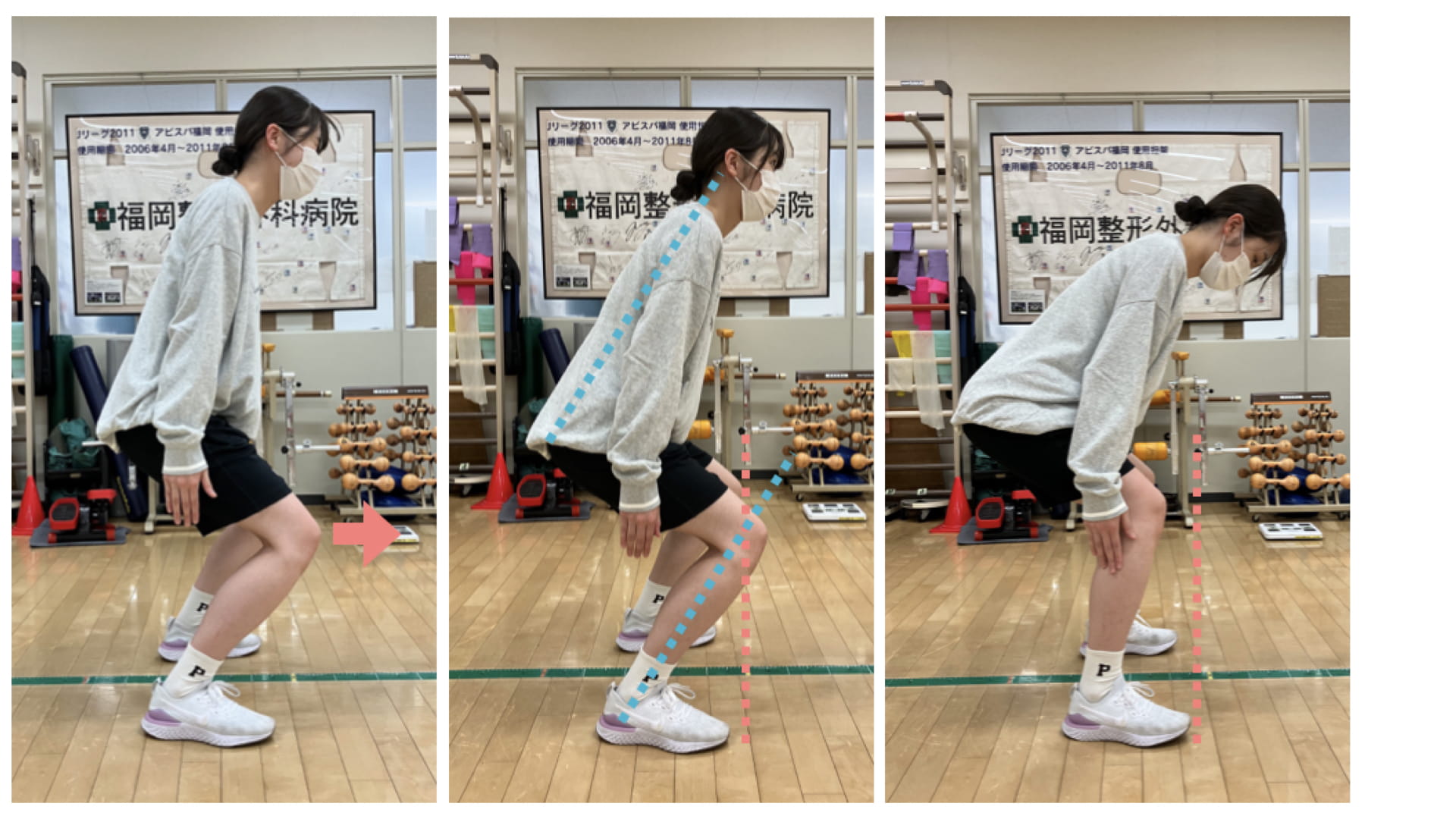 ACL再建術後のスポーツ復帰率は？小児・青年期アスリートの実態