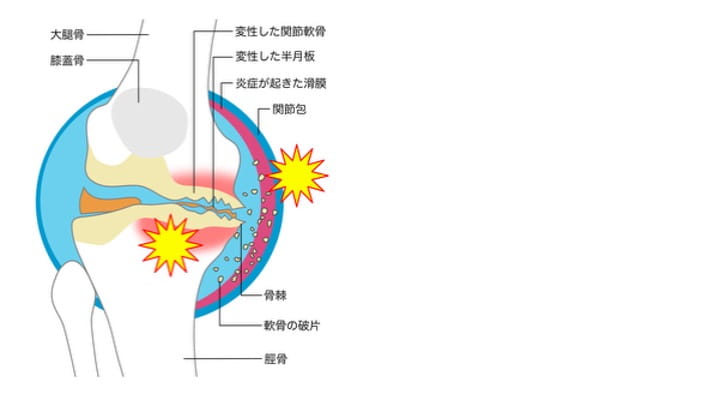 変形性膝関節症に対する機能解剖学に基づいた理学療法｜福岡整形外科