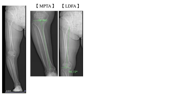 変形性膝関節症に対する機能解剖学に基づいた理学療法｜福岡整形外科