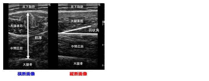 運動器エコー -骨格筋評価のために必要な知識とその可能性-｜中村雅俊
