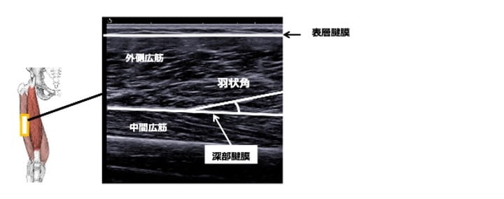 運動器エコー -骨格筋評価のために必要な知識とその可能性-｜中村雅俊